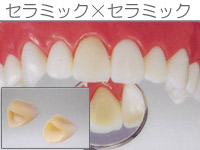 プラスチックインレー