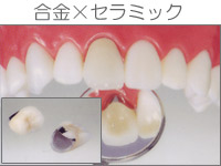 プラスチックインレー