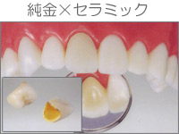 プラスチックインレー