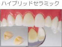 プラスチックインレー