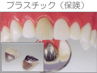 プラスチックインレー