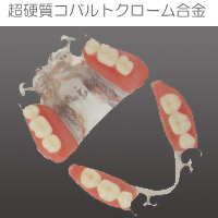 プラスチックインレー