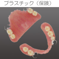 プラスチックインレー