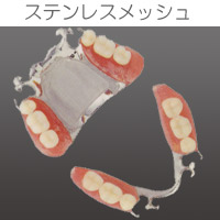 プラスチックインレー