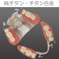 プラスチックインレー